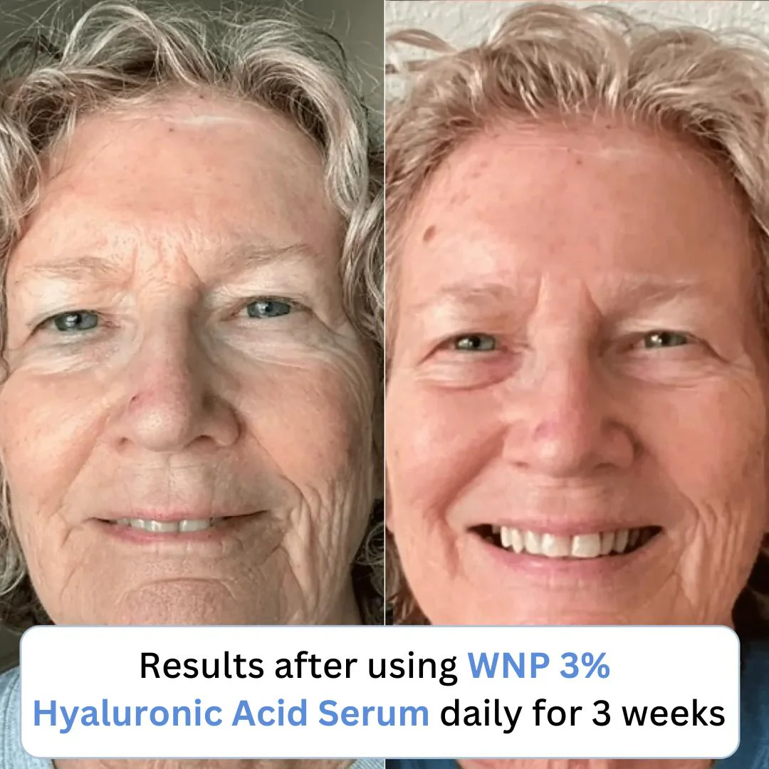 Saronto™ 3% Hyaluronic Acid WNP Serum